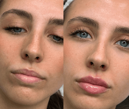 tratamiento de labios